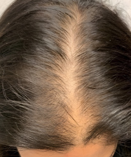 Adelgazamiento del cabello